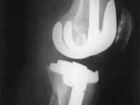 Arthrose Kniegelenksprothese
